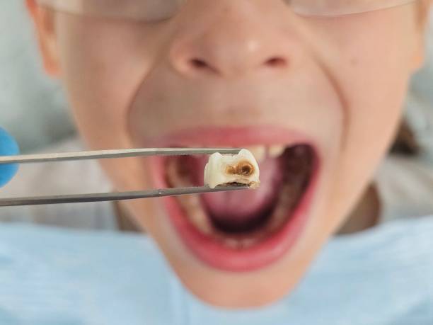 Best Emergency Dentist for Knocked-Out Tooth in Rossville, GA